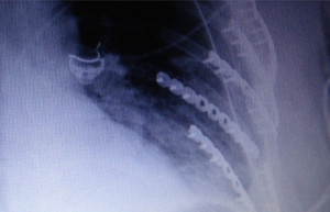 An x-ray of Barbara's ribs after the procedure.