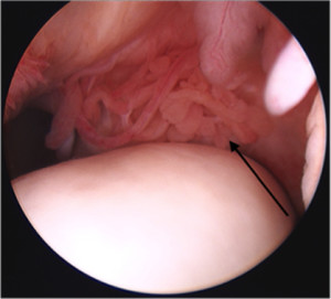 An arthroscopic image of an equine joint. The arrow points to synovium prior to collection.